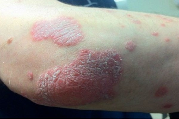 Ni slučajno ne bacajte Koru od ove voćke: Liječi Psorijazu, skida Bradavice i izbjeljuje Zube!! Ni slučajno ne bacajte Koru od ove voćke: Liječi Psorijazu, skida Bradavice i izbjeljuje Zube!!
